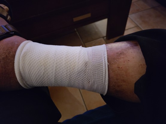 been in strak verband om een miniem langzaam bloedend wondje te stelpen